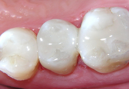 white-fillings-milton-keynes